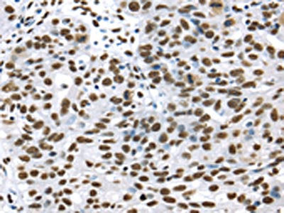 The image on the left is immunohistochemistry of paraffin-embedded Human breast cancer tissue using CSB-PA279529(DDX39B Antibody) at dilution 1/35, on the right is treated with synthetic peptide. (Original magnification: ×200)