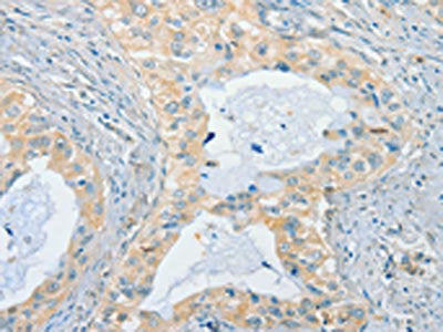 The image on the left is immunohistochemistry of paraffin-embedded Human cervical cancer tissue using CSB-PA279534(CHRNA2 Antibody) at dilution 1/40, on the right is treated with synthetic peptide. (Original magnification: ×200)