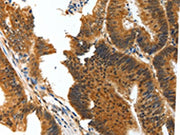 The image on the left is immunohistochemistry of paraffin-embedded Human colon cancer tissue using CSB-PA279642(BIRC6 Antibody) at dilution 1/30, on the right is treated with synthetic peptide. (Original magnification: ×200)