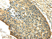 The image on the left is immunohistochemistry of paraffin-embedded Human esophagus cancer tissue using CSB-PA279846(SDF4 Antibody) at dilution 1/40, on the right is treated with fusion protein. (Original magnification: ×200)