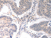 The image on the left is immunohistochemistry of paraffin-embedded Human colon cancer tissue using CSB-PA279895(ICOSLG Antibody) at dilution 1/30, on the right is treated with synthetic peptide. (Original magnification: ×200)