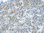 The image on the left is immunohistochemistry of paraffin-embedded Human liver cancer tissue using CSB-PA279988(VLDLR Antibody) at dilution 1/35, on the right is treated with synthetic peptide. (Original magnification: ×200)