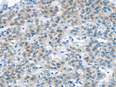 The image on the left is immunohistochemistry of paraffin-embedded Human liver cancer tissue using CSB-PA279988(VLDLR Antibody) at dilution 1/35, on the right is treated with synthetic peptide. (Original magnification: ×200)