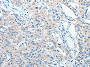 The image on the left is immunohistochemistry of paraffin-embedded Human lung cancer tissue using CSB-PA280169(AKAP9 Antibody) at dilution 1/10, on the right is treated with fusion protein. (Original magnification: ×200)