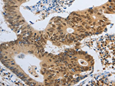 The image on the left is immunohistochemistry of paraffin-embedded Human colon cancer tissue using CSB-PA280193(POU2F2 Antibody) at dilution 1/40, on the right is treated with fusion protein. (Original magnification: ×200)