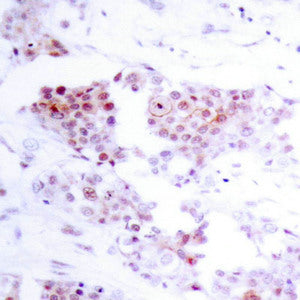 Immunohistochemical analysis of paraffin-embedded human breast carcinoma tissue using MEF2A(Ab-319) Antibody