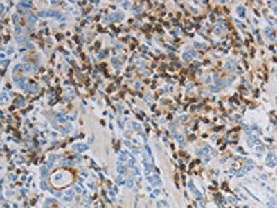 The image on the left is immunohistochemistry of paraffin-embedded Human gastic cancer tissue using CSB-PA280481(PARD6A Antibody) at dilution 1/40, on the right is treated with synthetic peptide. (Original magnification: ×200)
