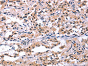 The image on the left is immunohistochemistry of paraffin-embedded Human thyroid cancer tissue using CSB-PA280621(ORAI1 Antibody) at dilution 1/25, on the right is treated with synthetic peptide. (Original magnification: ×200)