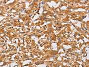 The image on the left is immunohistochemistry of paraffin-embedded Human thyroid cancer tissue using CSB-PA280628(OLR1 Antibody) at dilution 1/50, on the right is treated with fusion protein. (Original magnification: ×200)