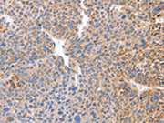 The image on the left is immunohistochemistry of paraffin-embedded Human liver cancer tissue using CSB-PA280651(B3GAT1 Antibody) at dilution 1/50, on the right is treated with synthetic peptide. (Original magnification: ×200)