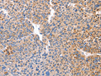 The image on the left is immunohistochemistry of paraffin-embedded Human liver cancer tissue using CSB-PA280651(B3GAT1 Antibody) at dilution 1/50, on the right is treated with synthetic peptide. (Original magnification: ×200)