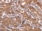 The image on the left is immunohistochemistry of paraffin-embedded Human gastic cancer tissue using CSB-PA280714(SIGLEC5 Antibody) at dilution 1/30, on the right is treated with fusion protein. (Original magnification: ×200)