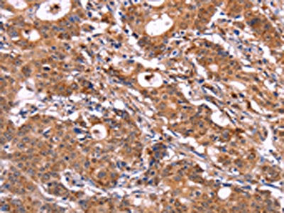 The image on the left is immunohistochemistry of paraffin-embedded Human gastic cancer tissue using CSB-PA280714(SIGLEC5 Antibody) at dilution 1/30, on the right is treated with fusion protein. (Original magnification: ×200)