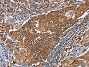 The image on the left is immunohistochemistry of paraffin-embedded Human cervical cancer tissue using CSB-PA280859(PMPCB Antibody) at dilution 1/50, on the right is treated with fusion protein. (Original magnification: ×200)
