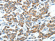 The image on the left is immunohistochemistry of paraffin-embedded Human breast cancer tissue using CSB-PA280938(ALDH6A1 Antibody) at dilution 1/45, on the right is treated with fusion protein. (Original magnification: ×200)