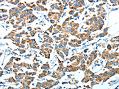 The image on the left is immunohistochemistry of paraffin-embedded Human breast cancer tissue using CSB-PA280938(ALDH6A1 Antibody) at dilution 1/45, on the right is treated with fusion protein. (Original magnification: ×200)