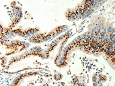 The image on the left is immunohistochemistry of paraffin-embedded Human colon cancer tissue using CSB-PA281056(TRPC6 Antibody) at dilution 1/40, on the right is treated with synthetic peptide. (Original magnification: ×200)