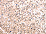 The image on the left is immunohistochemistry of paraffin-embedded Human esophagus cancer tissue using CSB-PA281213(TXN Antibody) at dilution 1/20, on the right is treated with synthetic peptide. (Original magnification: ×200)