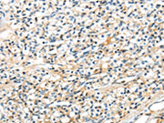 The image on the left is immunohistochemistry of paraffin-embedded Human prostate cancer tissue using CSB-PA281274(TSPYL6 Antibody) at dilution 1/20, on the right is treated with synthetic peptide. (Original magnification: ×200)