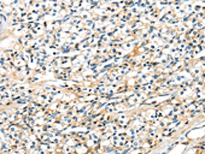 The image on the left is immunohistochemistry of paraffin-embedded Human prostate cancer tissue using CSB-PA281274(TSPYL6 Antibody) at dilution 1/20, on the right is treated with synthetic peptide. (Original magnification: ×200)