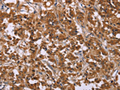 The image on the left is immunohistochemistry of paraffin-embedded Human thyroid cancer tissue using CSB-PA281322(CMTM6 Antibody) at dilution 1/30, on the right is treated with synthetic peptide. (Original magnification: ×200)