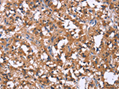 The image on the left is immunohistochemistry of paraffin-embedded Human thyroid cancer tissue using CSB-PA281418(SLC52A1 Antibody) at dilution 1/40, on the right is treated with synthetic peptide. (Original magnification: ×200)