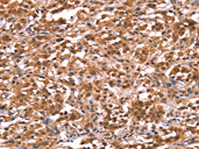 The image on the left is immunohistochemistry of paraffin-embedded Human thyroid cancer tissue using CSB-PA281738(AMER1 Antibody) at dilution 1/40, on the right is treated with synthetic peptide. (Original magnification: ×200)
