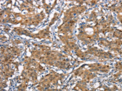 The image on the left is immunohistochemistry of paraffin-embedded Human gastic cancer tissue using CSB-PA281759(CDC25A Antibody) at dilution 1/50, on the right is treated with synthetic peptide. (Original magnification: ×200)