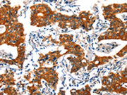 The image on the left is immunohistochemistry of paraffin-embedded Human gastic cancer tissue using CSB-PA281819(HTR3B Antibody) at dilution 1/30, on the right is treated with synthetic peptide. (Original magnification: ×200)