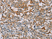 The image on the left is immunohistochemistry of paraffin-embedded Human liver cancer tissue using CSB-PA281967(MSR1 Antibody) at dilution 1/30, on the right is treated with fusion protein. (Original magnification: ×200)