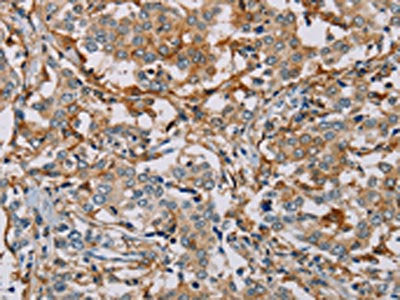 The image on the left is immunohistochemistry of paraffin-embedded Human liver cancer tissue using CSB-PA281967(MSR1 Antibody) at dilution 1/30, on the right is treated with fusion protein. (Original magnification: ×200)