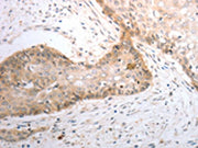 The image on the left is immunohistochemistry of paraffin-embedded Human cervical cancer tissue using CSB-PA281969(SLC1A4 Antibody) at dilution 1/40, on the right is treated with synthetic peptide. (Original magnification: ×200)