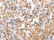 The image on the left is immunohistochemistry of paraffin-embedded Human thyroid cancer tissue using CSB-PA282084(CPSF4 Antibody) at dilution 1/30, on the right is treated with fusion protein. (Original magnification: ×200)