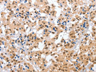 The image on the left is immunohistochemistry of paraffin-embedded Human thyroid cancer tissue using CSB-PA282084(CPSF4 Antibody) at dilution 1/30, on the right is treated with fusion protein. (Original magnification: ×200)