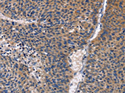 The image on the left is immunohistochemistry of paraffin-embedded Human liver cancer tissue using CSB-PA282230(PRKCD Antibody) at dilution 1/30, on the right is treated with fusion protein. (Original magnification: ×200)