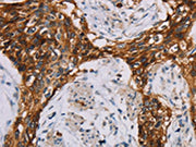 The image on the left is immunohistochemistry of paraffin-embedded Human esophagus cancer tissue using CSB-PA282285(CD44 Antibody) at dilution 1/35, on the right is treated with fusion protein. (Original magnification: ×200)
