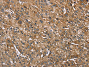 The image on the left is immunohistochemistry of paraffin-embedded Human liver cancer tissue using CSB-PA282529(IQCJ Antibody) at dilution 1/35, on the right is treated with synthetic peptide. (Original magnification: ×200)