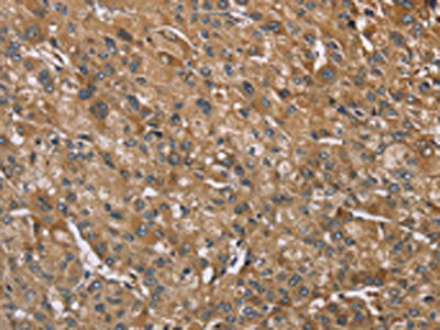 The image on the left is immunohistochemistry of paraffin-embedded Human liver cancer tissue using CSB-PA282529(IQCJ Antibody) at dilution 1/35, on the right is treated with synthetic peptide. (Original magnification: ×200)