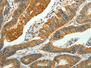 The image on the left is immunohistochemistry of paraffin-embedded Human colon cancer tissue using CSB-PA282609(PTPN6 Antibody) at dilution 1/35, on the right is treated with fusion protein. (Original magnification: ×200)