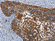 The image on the left is immunohistochemistry of paraffin-embedded Human cervical cancer tissue using CSB-PA282654(CD68 Antibody) at dilution 1/30, on the right is treated with synthetic peptide. (Original magnification: ×200)