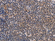 The image on the left is immunohistochemistry of paraffin-embedded Human Lymphoma tissue using CSB-PA282659(POU4F1 Antibody) at dilution 1/25, on the right is treated with synthetic peptide. (Original magnification: ×200)