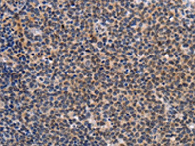 The image on the left is immunohistochemistry of paraffin-embedded Human Lymphoma tissue using CSB-PA282659(POU4F1 Antibody) at dilution 1/25, on the right is treated with synthetic peptide. (Original magnification: ×200)