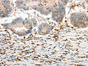 The image on the left is immunohistochemistry of paraffin-embedded Human colon cancer tissue using CSB-PA282697(PTTG1 Antibody) at dilution 1/30, on the right is treated with synthetic peptide. (Original magnification: ×200)