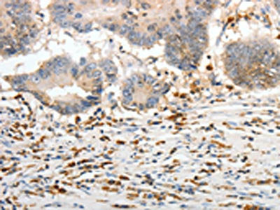 The image on the left is immunohistochemistry of paraffin-embedded Human colon cancer tissue using CSB-PA282697(PTTG1 Antibody) at dilution 1/30, on the right is treated with synthetic peptide. (Original magnification: ×200)