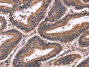 The image on the left is immunohistochemistry of paraffin-embedded Human colon cancer tissue using CSB-PA282707(SEPT7 Antibody) at dilution 1/60, on the right is treated with fusion protein. (Original magnification: ×200)