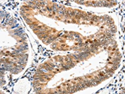The image on the left is immunohistochemistry of paraffin-embedded Human cervical cancer tissue using CSB-PA282824(DDB1 Antibody) at dilution 1/25, on the right is treated with synthetic peptide. (Original magnification: ×200)