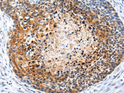 The image on the left is immunohistochemistry of paraffin-embedded Human esophagus cancer tissue using CSB-PA282851(ZFP30 Antibody) at dilution 1/25, on the right is treated with synthetic peptide. (Original magnification: ×200)