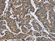 The image on the left is immunohistochemistry of paraffin-embedded Human breast cancer tissue using CSB-PA283024(DHRS3 Antibody) at dilution 1/30, on the right is treated with fusion protein. (Original magnification: ×200)