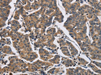 The image on the left is immunohistochemistry of paraffin-embedded Human breast cancer tissue using CSB-PA283024(DHRS3 Antibody) at dilution 1/30, on the right is treated with fusion protein. (Original magnification: ×200)