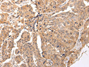 The image on the left is immunohistochemistry of paraffin-embedded Human breast cancer tissue using CSB-PA283108(CLDND2 Antibody) at dilution 1/45, on the right is treated with synthetic peptide. (Original magnification: ×200)